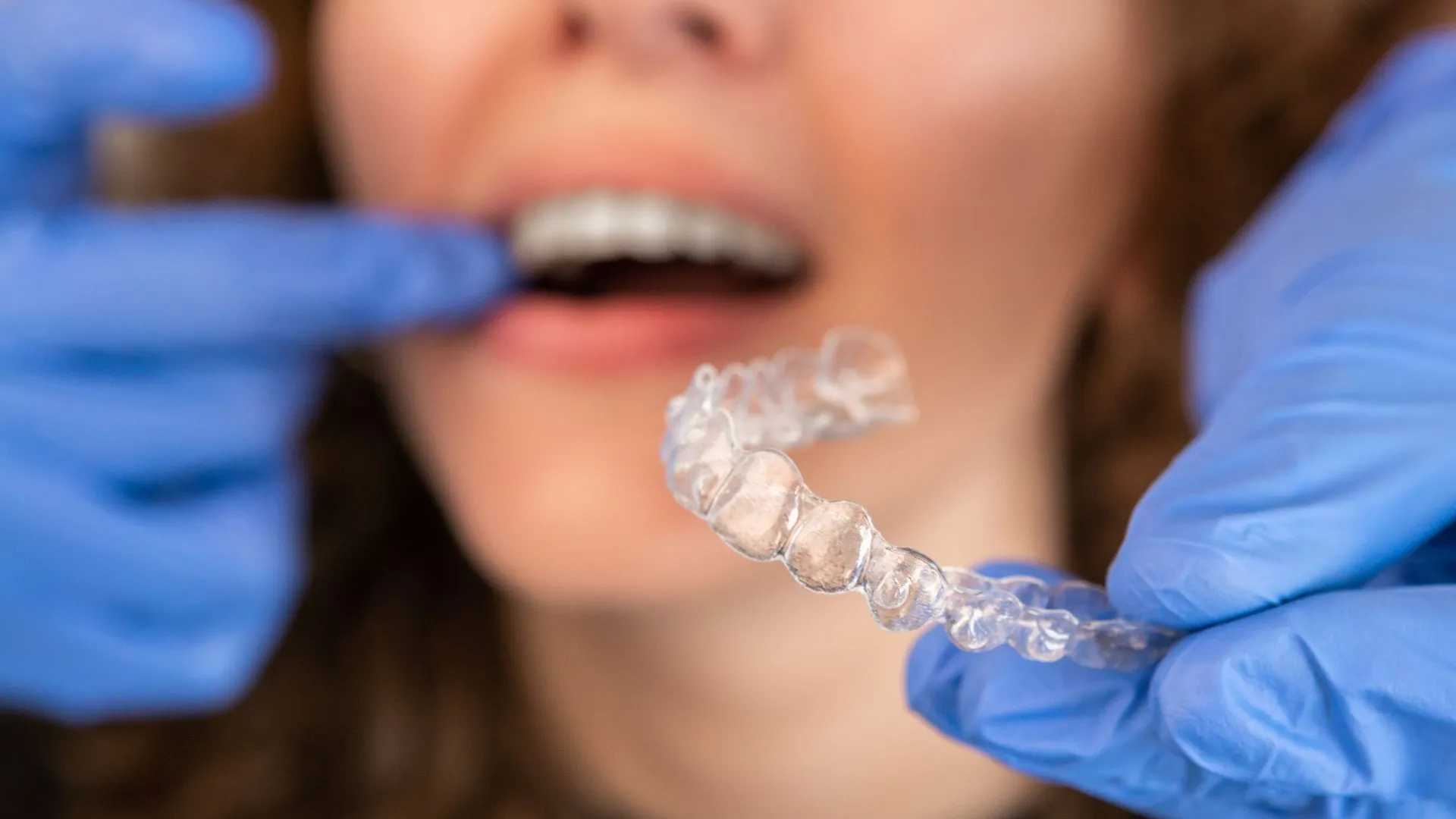 4 Problems that Invisalign Corrects
