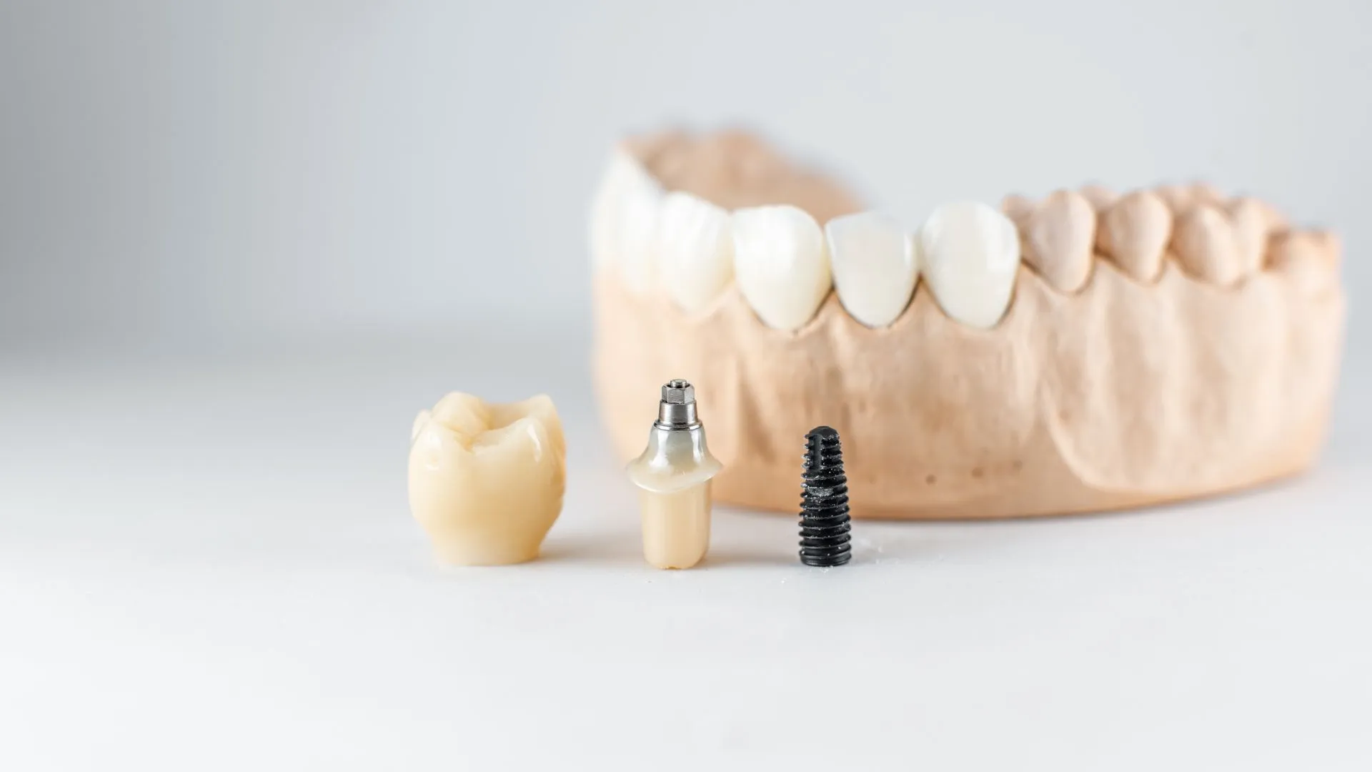 Discovering the Different Types of Dental Implants