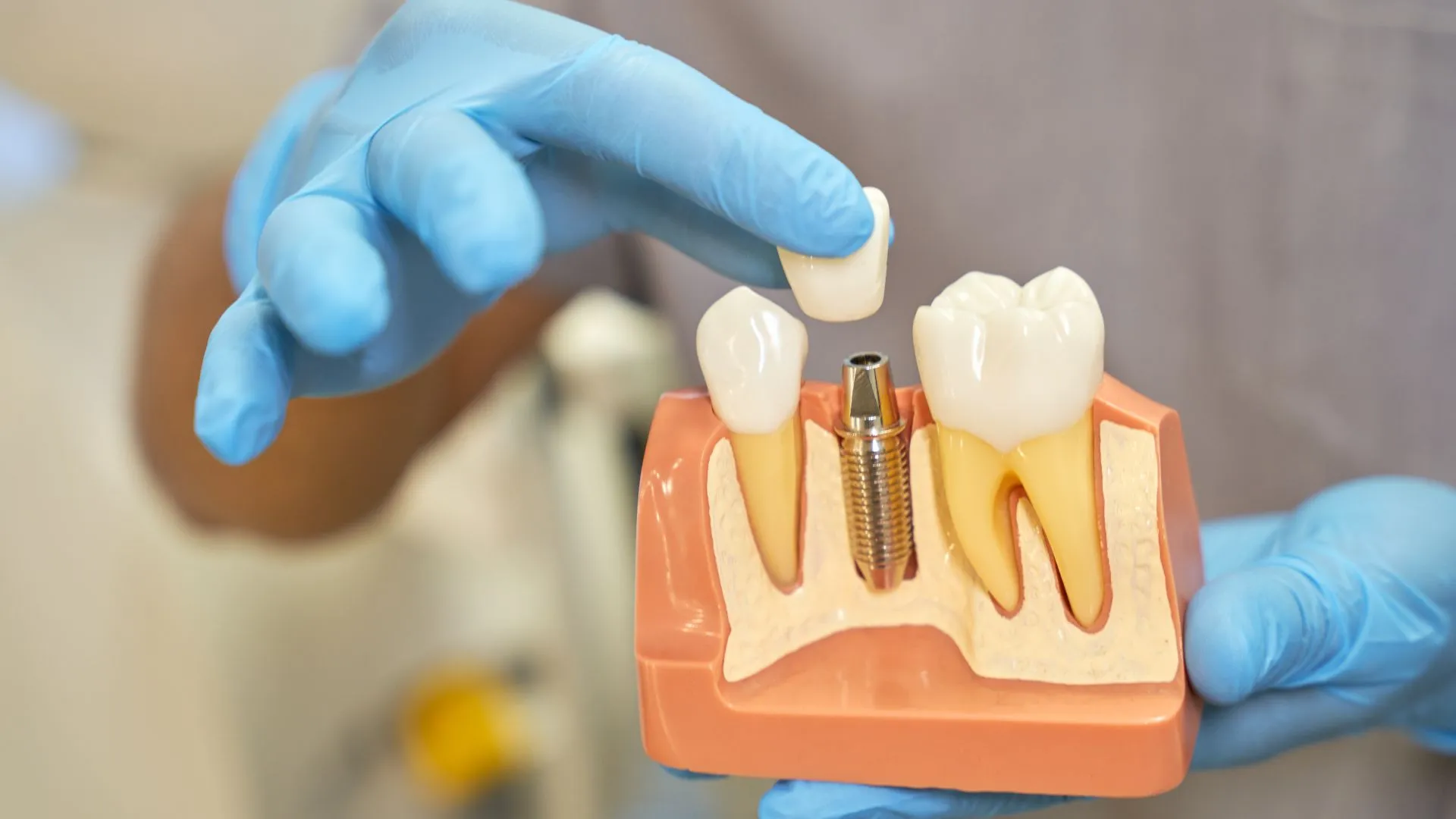 What Are the Steps After Dental Implant Surgery