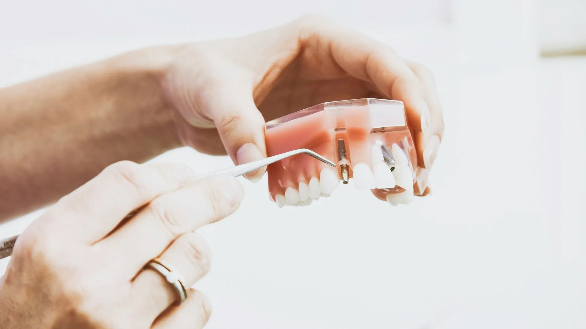 What Your Dentist Means When They Say You Need a Bone Graft