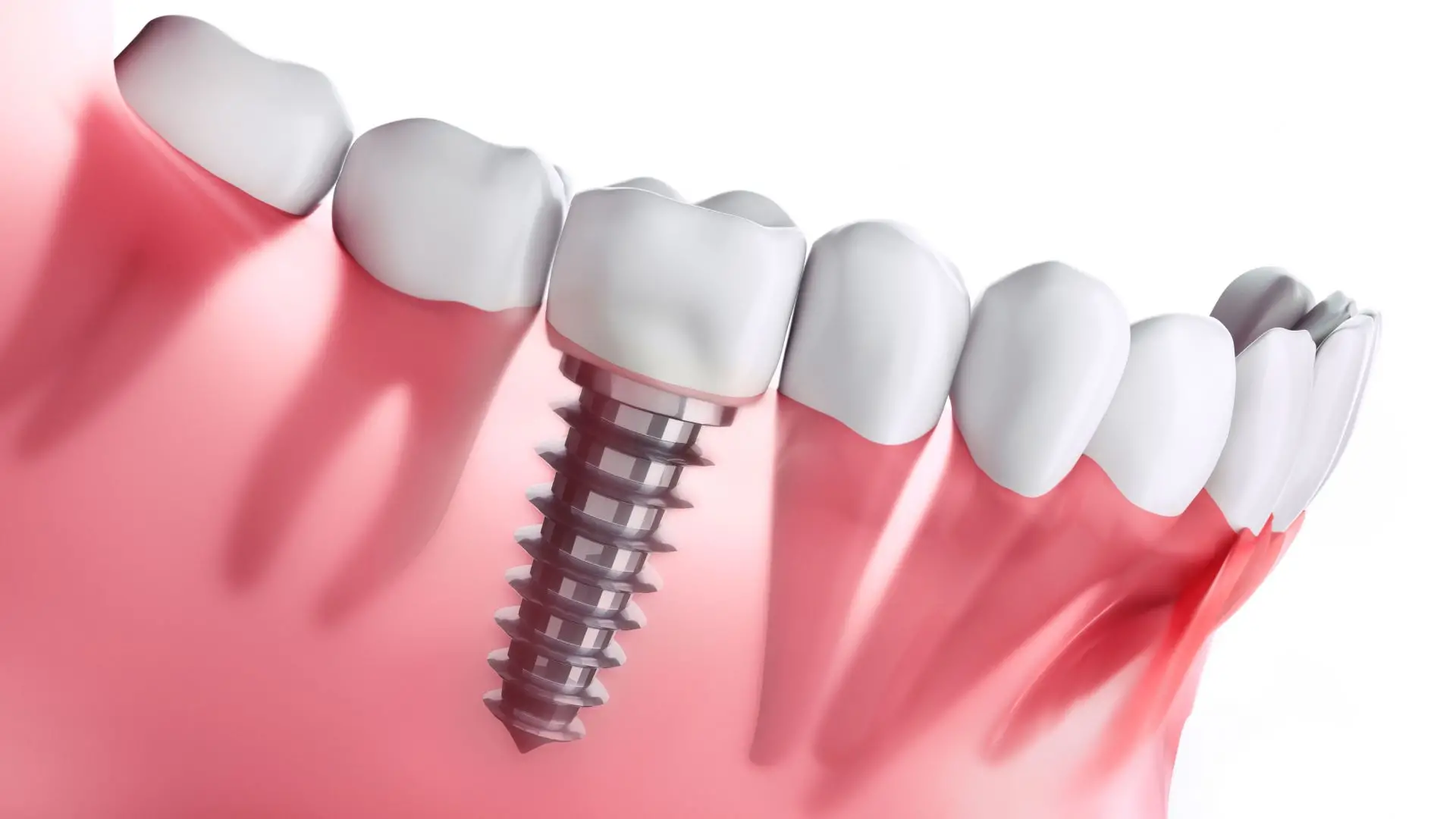 Dental Implants: Your Solution to Missing Teeth