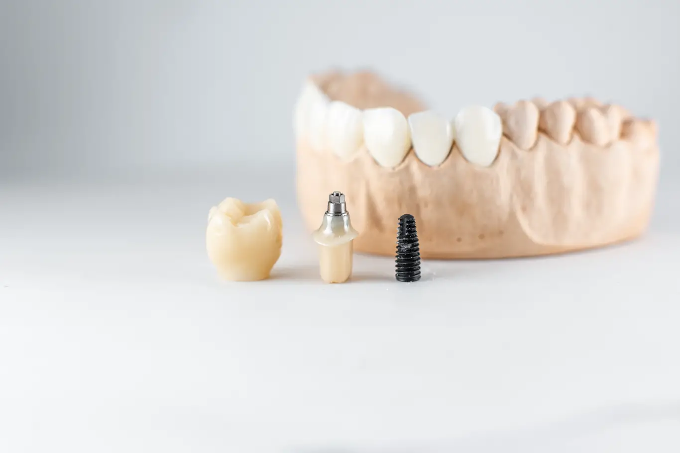Model of an artificial jaw and dental implant