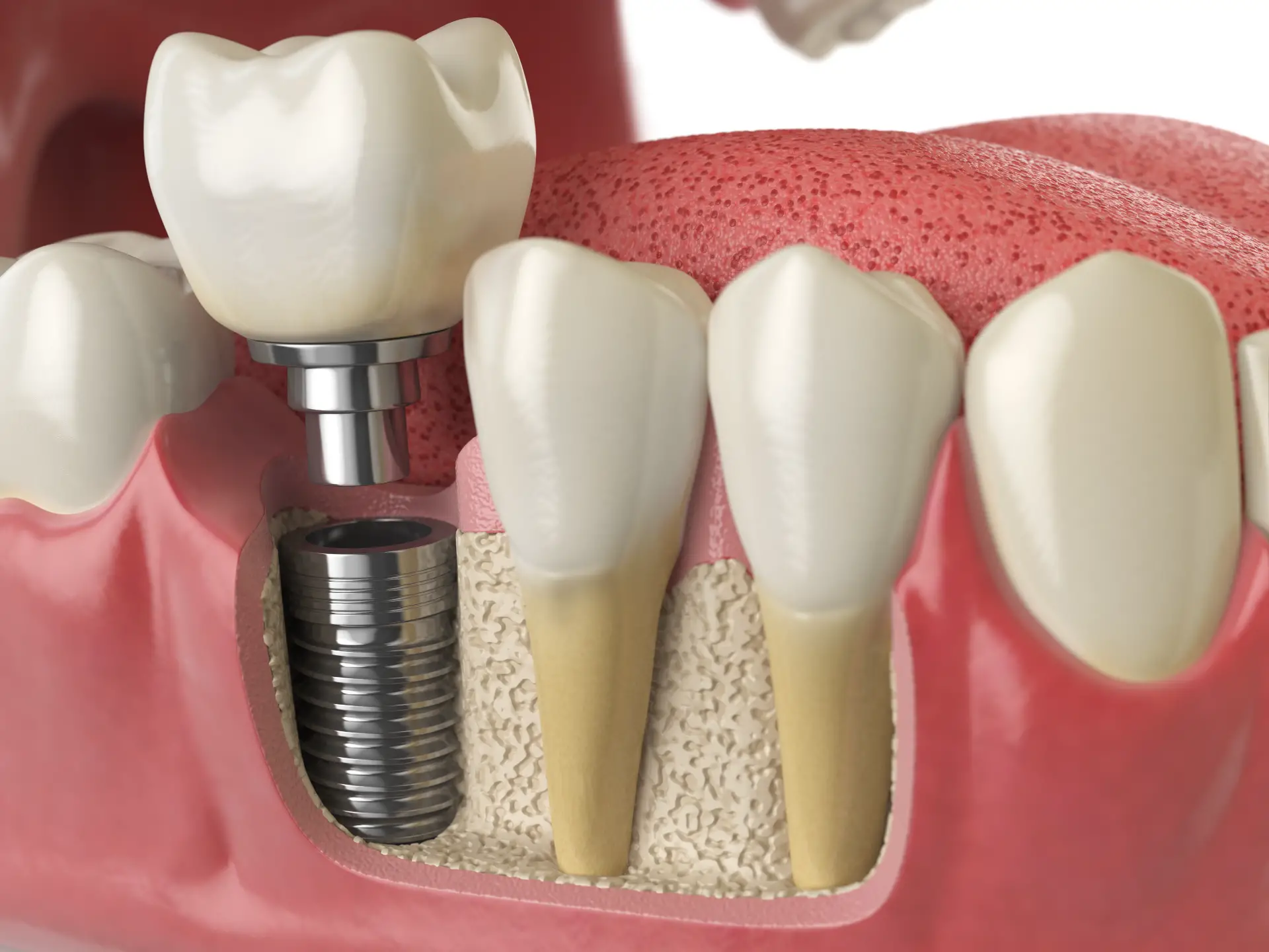Why the Success Rate of Dental Implants Makes Them Worth It